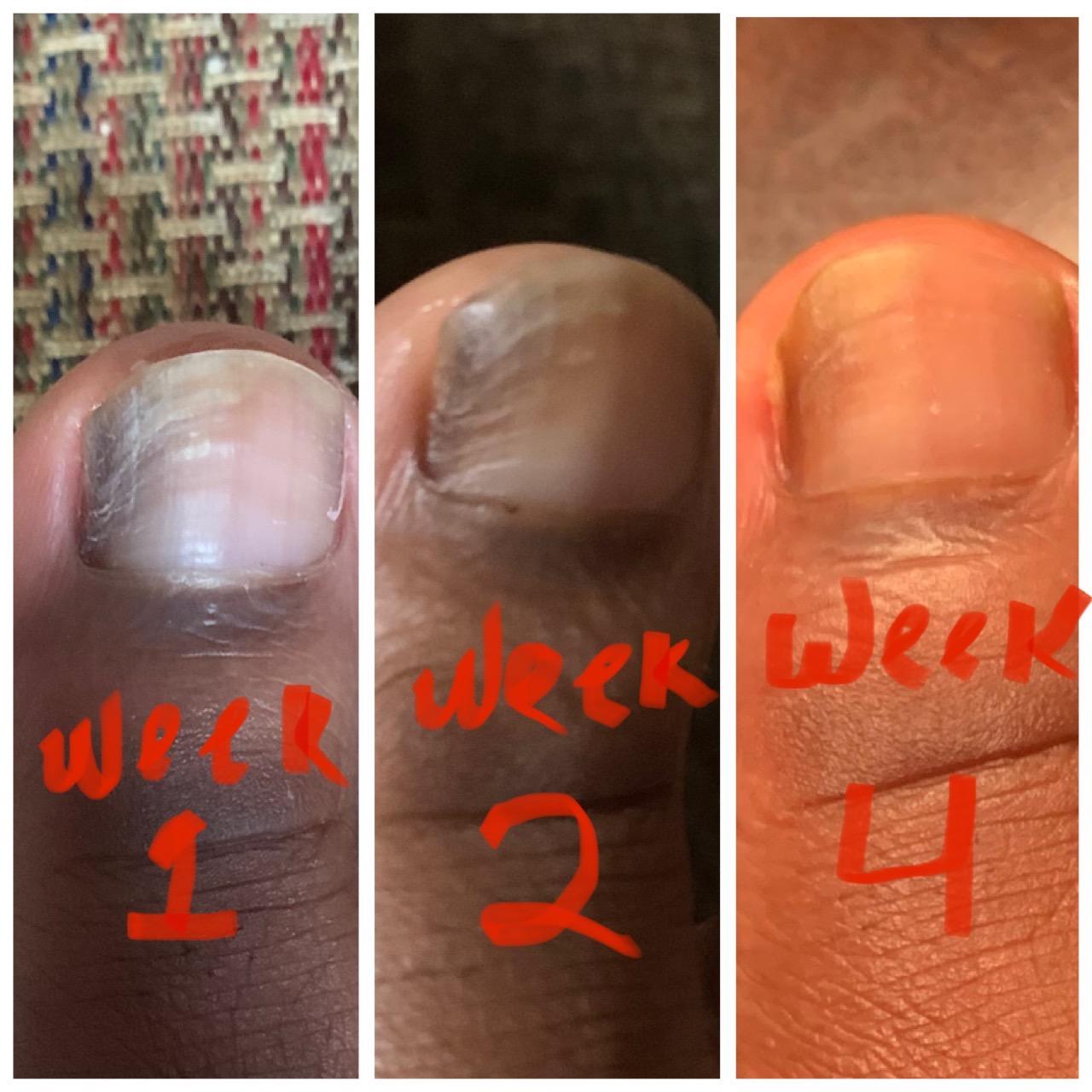 HealthyNail Pen – Restore Beautiful Nails in Just 4 Weeks