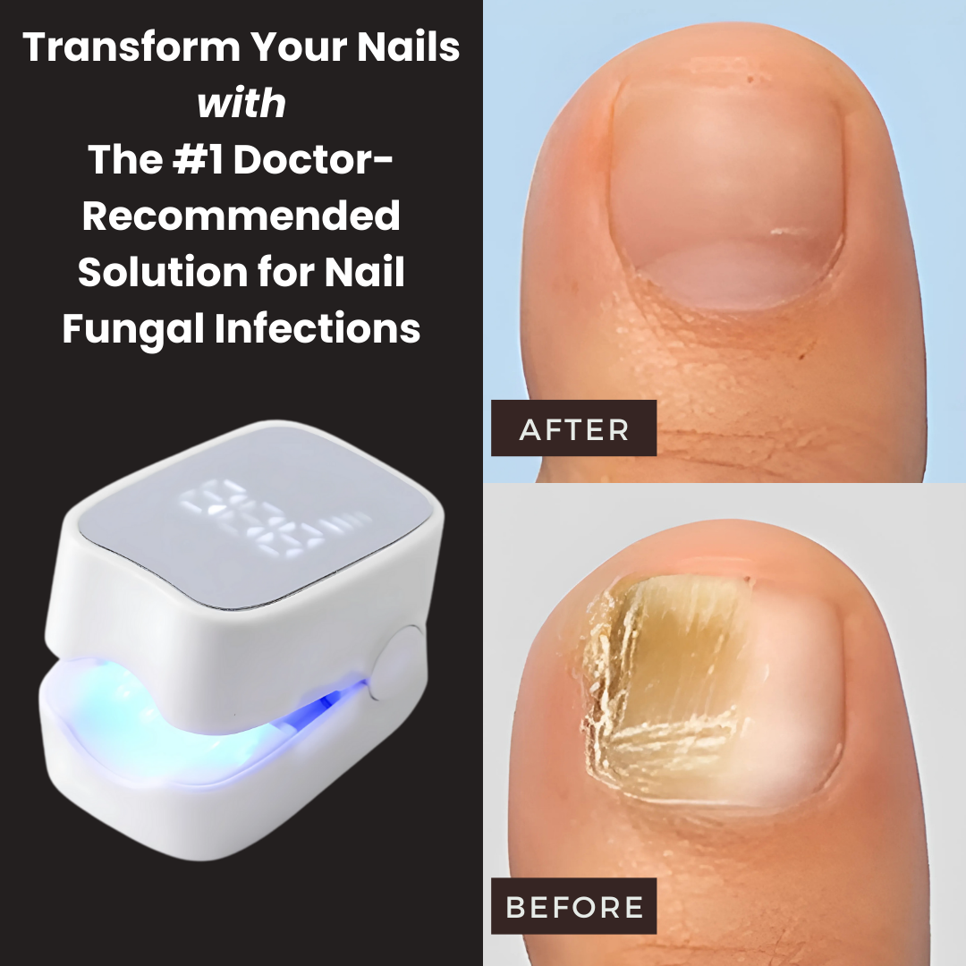 Sunposus Pro ™ – Nail Fungus Laser Device Solution