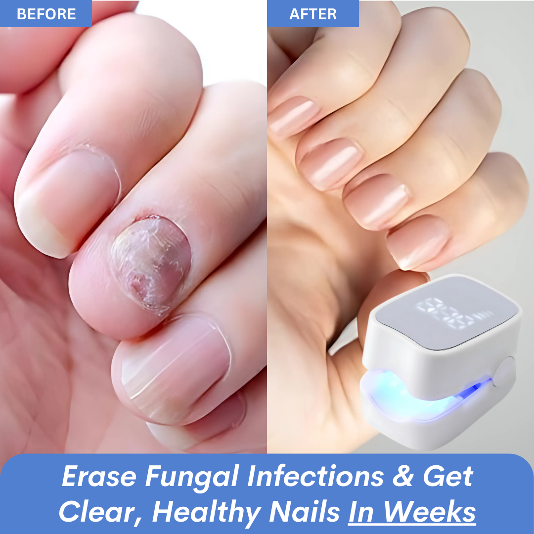 Sunposus Pro ™ – Nail Fungus Laser Device Solution