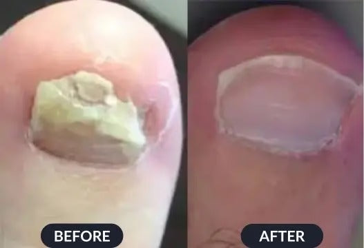 HealthyNail Pen – Restore Beautiful Nails in Just 4 Weeks